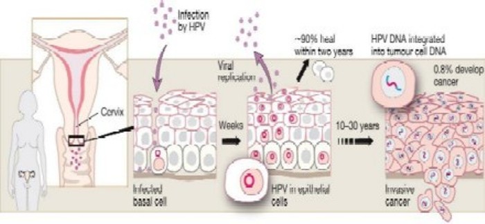 Proceso de infección del virus papiloma humano - VPH - causante deel cáncer cervicouterino. (Foto: Fundación Nobel