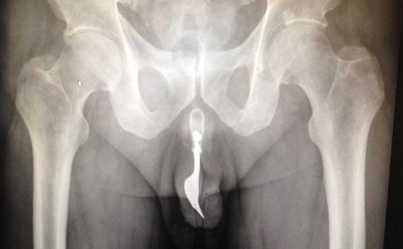 La radiografía muestra un tenedor de metal de 10 centímetros de largo dentro del pene (Foto: The International Journal of Surgery) PULSAR PARA AMPLIAR -