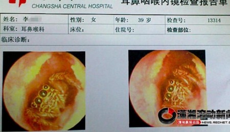 La araña se había instalado dentro del oído de una mujer. (Foto: Changsha Central Hospital) - PULSAR PARA AMPLIAR -