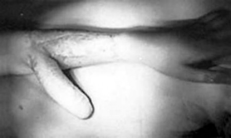 Así se cultiva un nuevo pene en el antebrazo de un adolescente (Foto: Hospital) - PULSAR PARA AMPLIAR -